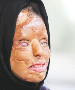Sonali Mukherjee, who suffered an acid attack at 17 